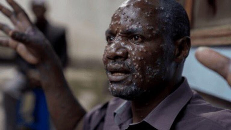 Africa Mpox